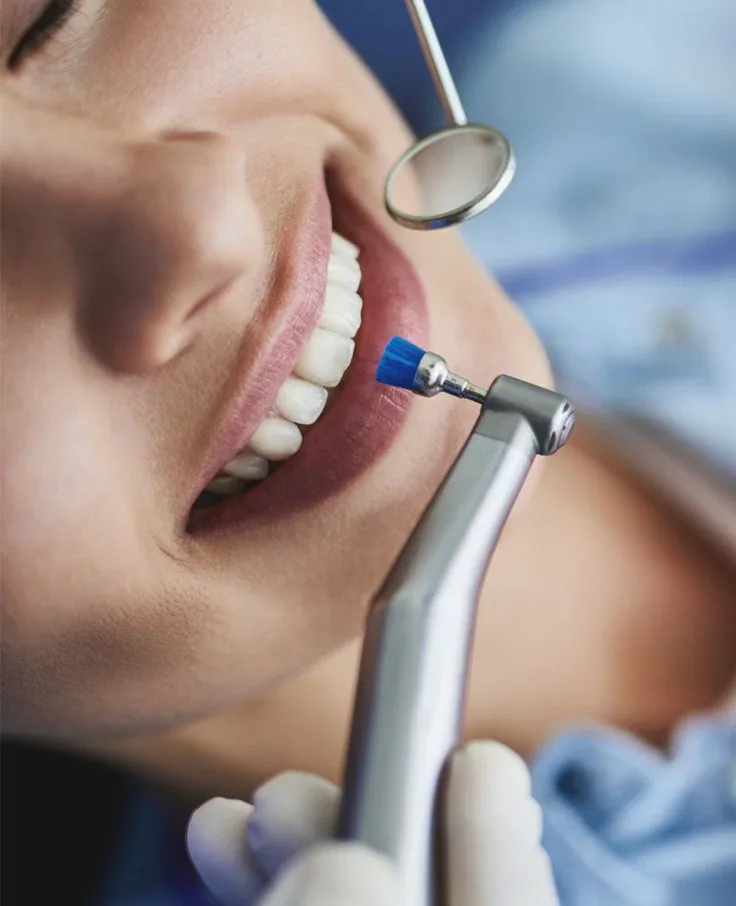 Procedimiento de limpieza dental en Red Bucal Clínicas Dentales, Colón